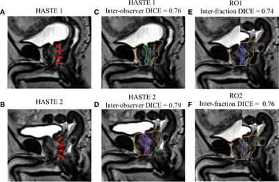 Urethral Interfractional Geometric and Dosimetric Variations of Prostate Cancer Patients: A Study Using an Onboard MRI